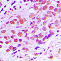 XPA Antibody - Immunohistochemical analysis of XPA staining in human breast cancer formalin fixed paraffin embedded tissue section. The section was pre-treated using heat mediated antigen retrieval with sodium citrate buffer (pH 6.0). The section was then incubated with the antibody at room temperature and detected using an HRP conjugated compact polymer system. DAB was used as the chromogen. The section was then counterstained with hematoxylin and mounted with DPX.