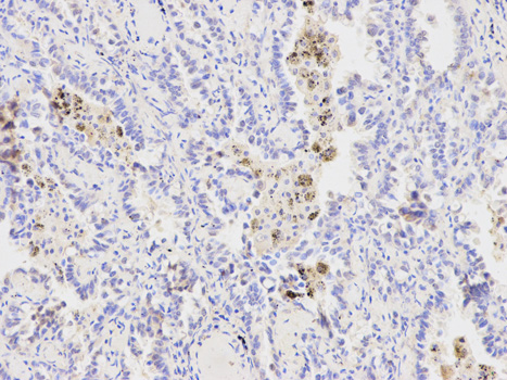XPA Antibody - Immunohistochemistry of paraffin-embedded human lung cancer using XPA antibody at dilution of 1:200 (200x lens).