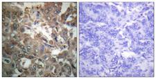 XPA Antibody - Peptide - + Immunohistochemistry analysis of paraffin-embedded human breast carcinoma tissue using XPA antibody.