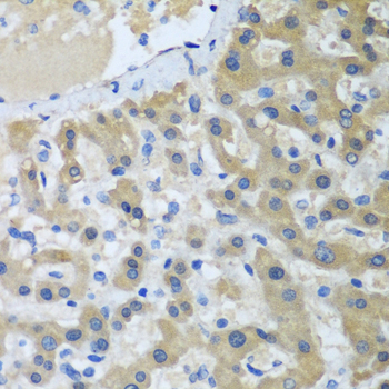 XPC Antibody - Immunohistochemistry of paraffin-embedded human liver cancer tissue.