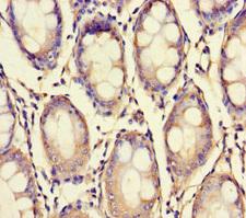 XPNPEP1 / Aminopeptidase P Antibody - Immunohistochemistry of paraffin-embedded human colon cancer using XPNPEP1 Antibody at dilution of 1:100