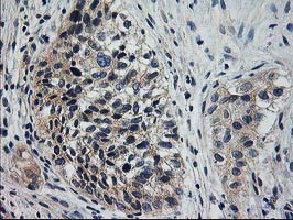 XPNPEP3 Antibody - IHC of paraffin-embedded Carcinoma of Human bladder tissue using anti-XPNPEP3 mouse monoclonal antibody. (Heat-induced epitope retrieval by 10mM citric buffer, pH6.0, 100C for 10min).