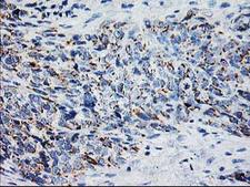 XPNPEP3 Antibody - IHC of paraffin-embedded Adenocarcinoma of Human colon tissue using anti-XPNPEP3 mouse monoclonal antibody.
