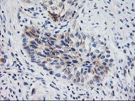 XPNPEP3 Antibody - IHC of paraffin-embedded Carcinoma of Human bladder tissue using anti-XPNPEP3 mouse monoclonal antibody.