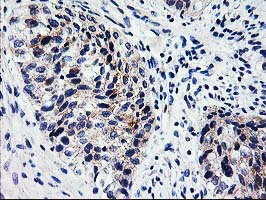 XPNPEP3 Antibody - IHC of paraffin-embedded Carcinoma of Human bladder tissue using anti-XPNPEP3 mouse monoclonal antibody.