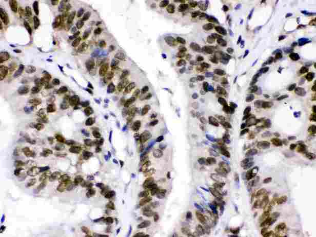 XPO1 / CRM1 Antibody - CRM1 was detected in paraffin-embedded sections of human intestinal cancer tissues using rabbit anti- CRM1 Antigen Affinity purified polyclonal antibody