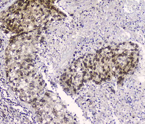 XPO1 / CRM1 Antibody - IHC analysis of CRM1 using anti-CRM1 antibody. CRM1 was detected in paraffin-embedded section of human lung cancer tissue. Heat mediated antigen retrieval was performed in citrate buffer (pH6, epitope retrieval solution) for 20 mins. The tissue section was blocked with 10% goat serum. The tissue section was then incubated with 2µg/ml mouse anti-CRM1 Antibody overnight at 4°C. Biotinylated goat anti-mouse IgG was used as secondary antibody and incubated for 30 minutes at 37°C. The tissue section was developed using Strepavidin-Biotin-Complex (SABC) with DAB as the chromogen.