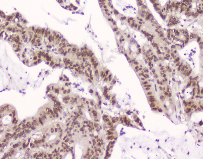XPO1 / CRM1 Antibody - IHC analysis of CRM1 using anti-CRM1 antibody. CRM1 was detected in paraffin-embedded section of human intestinal cancer tissue. Heat mediated antigen retrieval was performed in citrate buffer (pH6, epitope retrieval solution) for 20 mins. The tissue section was blocked with 10% goat serum. The tissue section was then incubated with 2µg/ml mouse anti-CRM1 Antibody overnight at 4°C. Biotinylated goat anti-mouse IgG was used as secondary antibody and incubated for 30 minutes at 37°C. The tissue section was developed using Strepavidin-Biotin-Complex (SABC) with DAB as the chromogen.