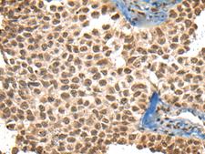 XPO1 / CRM1 Antibody - Immunohistochemistry of paraffin-embedded Human ovarian cancer tissue  using XPO1 Polyclonal Antibody at dilution of 1:40(×200)