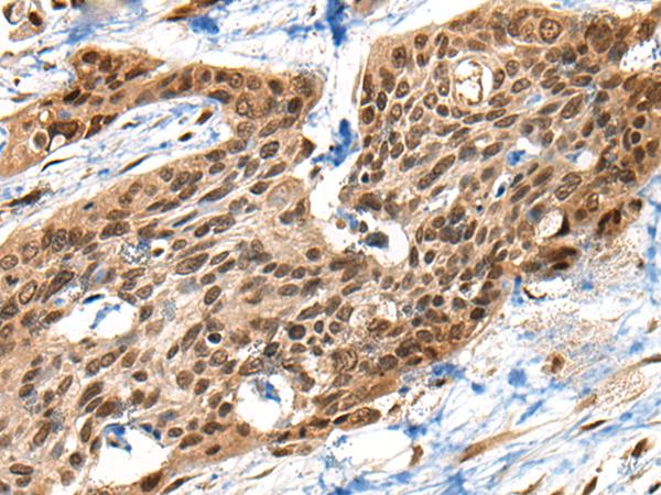 XPO1 / CRM1 Antibody - Immunohistochemistry of paraffin-embedded Human esophagus cancer tissue  using XPO1 Polyclonal Antibody at dilution of 1:40(×200)