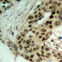 XPO5 / Exportin 5 Antibody - Immunohistochemical analysis of Exportin 5 staining in human ovarian cancer formalin fixed paraffin embedded tissue section. The section was pre-treated using heat mediated antigen retrieval with sodium citrate buffer (pH 6.0). The section was then incubated with the antibody at room temperature and detected using an HRP conjugated compact polymer system. DAB was used as the chromogen. The section was then counterstained with hematoxylin and mounted with DPX.