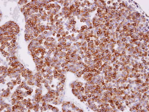 XPR1 Antibody - IHC of paraffin-embedded PITUITARY GLAND TUMOR using XPR1 antibody at 1:100 dilution.