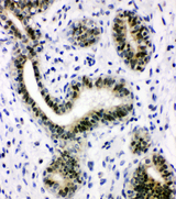 XRCC1 Antibody - XRCC1 antibody. IHC(P): Human Breast Cancer Tissue.