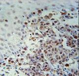 XRCC1 Antibody - XRCC1 Antibody immunohistochemistry of formalin-fixed and paraffin-embedded human skin carcinoma followed by peroxidase-conjugated secondary antibody and DAB staining.