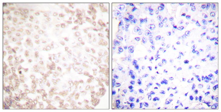XRCC1 Antibody - Immunohistochemistry analysis of paraffin-embedded human lung carcinoma tissue, using XRCC1 Antibody. The picture on the right is blocked with the synthesized peptide.