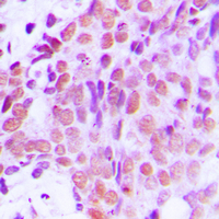 XRCC1 Antibody - Immunohistochemical analysis of XRCC1 staining in human breast cancer formalin fixed paraffin embedded tissue section. The section was pre-treated using heat mediated antigen retrieval with sodium citrate buffer (pH 6.0). The section was then incubated with the antibody at room temperature and detected using an HRP conjugated compact polymer system. DAB was used as the chromogen. The section was then counterstained with hematoxylin and mounted with DPX.