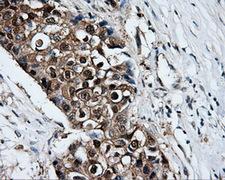 XRCC1 Antibody - Immunohistochemical staining of paraffin-embedded Adenocarcinoma of breast tissue using anti-XRCC1 mouse monoclonal antibody. (Dilution 1:50).
