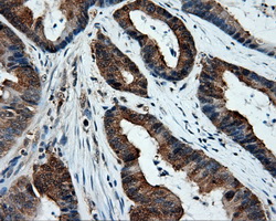 XRCC1 Antibody - Immunohistochemical staining of paraffin-embedded Adenocarcinoma of colon tissue using anti-XRCC1 mouse monoclonal antibody. (Dilution 1:50).