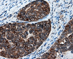 XRCC1 Antibody - Immunohistochemical staining of paraffin-embedded Adenocarcinoma of ovary tissue using anti-XRCC1 mouse monoclonal antibody. (Dilution 1:50).