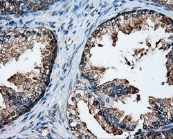 XRCC1 Antibody - Immunohistochemical staining of paraffin-embedded prostate tissue using anti-XRCC1 mouse monoclonal antibody. (Dilution 1:50).