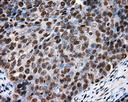 XRCC1 Antibody - Immunohistochemical staining of paraffin-embedded Adenocarcinoma of ovary tissue using anti- mouse monoclonal antibody. (Dilution 1:50).