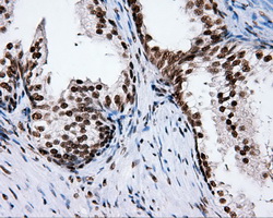 XRCC1 Antibody - Immunohistochemical staining of paraffin-embedded prostate tissue using anti- mouse monoclonal antibody. (Dilution 1:50).