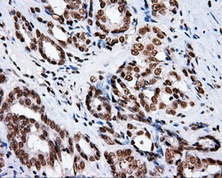 XRCC1 Antibody - Immunohistochemical staining of paraffin-embedded Carcinoma of prostate tissue using anti- mouse monoclonal antibody. (Dilution 1:50).