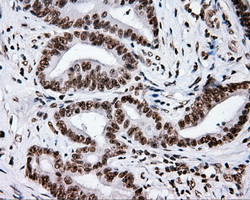 XRCC1 Antibody - Immunohistochemical staining of paraffin-embedded Adenocarcinoma of colon tissue using anti- mouse monoclonal antibody. (Dilution 1:50).