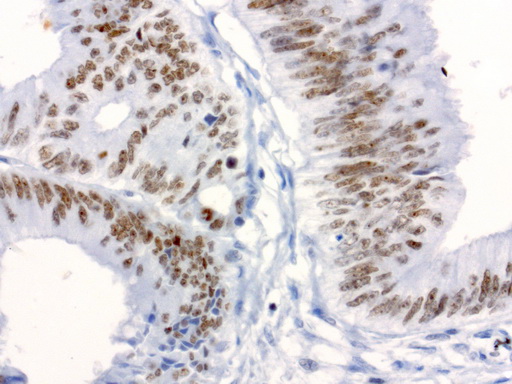XRCC1 Antibody - Immunohistochemical staining of paraffin-embedded human colon carcinoma using anti-XRCC1 clone UMAB40 mouse monoclonal antibody  at 1:50 with Polink2 Broad HRP DAB detection kit; heat-induced epitope retrieval with GBI Accel pH8.7 HIER buffer using pressure chamber for 3 minutes at 110C. Nuclear staining is seen in tumor cells.