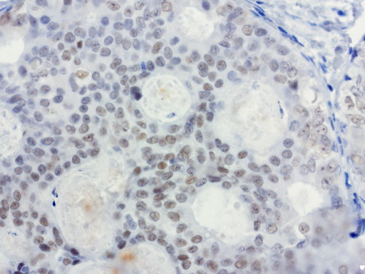 XRCC1 Antibody - Immunohistochemical staining of paraffin-embedded human breast carcinoma using anti-XRCC1 clone UMAB40 mouse monoclonal antibody  at 1:50 with Polink2 Broad HRP DAB detection kit; heat-induced epitope retrieval with GBI Accel pH8.7 HIER buffer using pressure chamber for 3 minutes at 110C. Weak nuclear staining is seen in tumor cells.