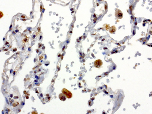XRCC1 Antibody - Immunohistochemical staining of paraffin-embedded human lung using anti-XRCC1 clone UMAB40 mouse monoclonal antibody  at 1:50 with Polink2 Broad HRP DAB detection kit; heat-induced epitope retrieval with GBI TEE pH9.0 HIER buffer using pressure chamber for 3 minutes at 110C. Nuclear staining is seen in epithelial cells.