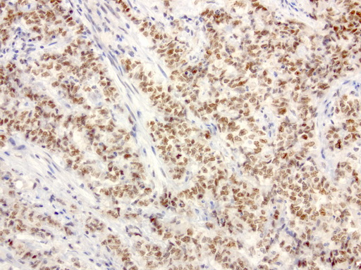 XRCC1 Antibody - Immunohistochemical staining of paraffin-embedded human endometrial carcinoma using anti-XRCC1 clone UMAB40 mouse monoclonal antibody  at 1:50 with Polink2 Broad HRP DAB detection kit; heat-induced epitope retrieval with GBI TEE pH9.0 HIER buffer using pressure chamber for 3 minutes at 110C. Nuclear staining is seen in tumor cells.