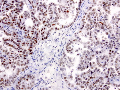 XRCC1 Antibody - Immunohistochemical staining of paraffin-embedded human ovarian carcinoma using anti-XRCC1 clone UMAB40 mouse monoclonal antibody  at 1:50 with Polink2 Broad HRP DAB detection kit; heat-induced epitope retrieval with GBI TEE pH9.0 HIER buffer using pressure chamber for 3 minutes at 110C. Nuclear staining is seen in tumor cells.