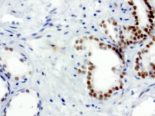 XRCC1 Antibody - Immunohistochemical staining of paraffin-embedded human prostate carcinoma using anti-XRCC1 clone UMAB40 mouse monoclonal antibody  at 1:50 with Polink2 Broad HRP DAB detection kit; heat-induced epitope retrieval with GBI TEE pH9.0 HIER buffer using pressure chamber for 3 minutes at 110C. Nuclear staining is seen in tumor cells.