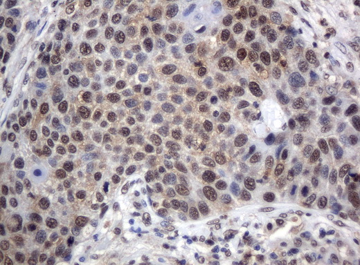 XRCC1 Antibody - Immunohistochemical staining of paraffin-embedded Carcinoma of lung tissue using anti-XRCC1 mouse monoclonal antibody.  dilution 1:50; heat-induced epitope retrieval by 10mM citric buffer, pH6.0, 120C for 3min)