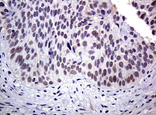 XRCC1 Antibody - Immunohistochemical staining of paraffin-embedded Carcinoma of bladder tissue using anti-XRCC1 mouse monoclonal antibody.  dilution 1:50; heat-induced epitope retrieval by 10mM citric buffer, pH6.0, 120C for 3min)
