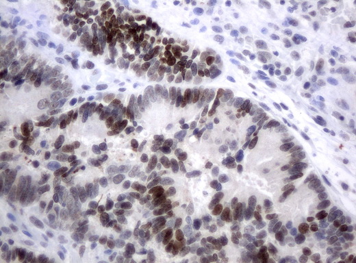 XRCC1 Antibody - Immunohistochemical staining of paraffin-embedded Adenocarcinoma of colon tissue using anti-XRCC1 mouse monoclonal antibody.  dilution 1:50; heat-induced epitope retrieval by 10mM citric buffer, pH6.0, 120C for 3min)