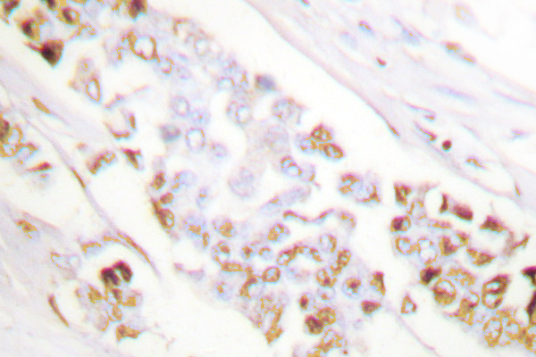 XRCC1 Antibody - IHC of XRCC1 (G552) pAb in paraffin-embedded human lung carcinoma tissue.