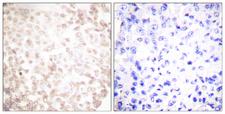 XRCC1 Antibody - Peptide - + Immunohistochemistry analysis of paraffin-embedded human lung carcinoma tissue using XRCC1 antibody.