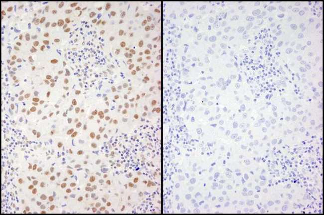 XRCC1 Antibody - Detection of Human Phospho XRCC1 (S461) by Immunohistochemistry. Samples: FFPE serial sections of human breast adenocarcinoma. Mock phosphatase treated section (left) or calf intestinal phosphatase-treated section (right) immunostained for Phospho XRCC1 (S461). Antibody: Affinity purified rabbit anti-Phospho XRCC1 (S461). used at a dilution of 1:250.