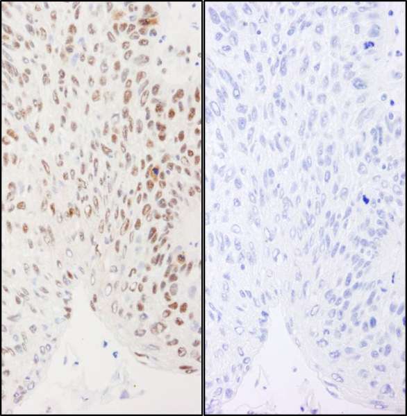 XRCC1 Antibody - Detection of Human Phospho XRCC1 (S461) by Immunohistochemistry. Samples: FFPE serial sections of human larynx squamous cell carcinoma. Mock phosphatase treated section (left) and calf intestinal phosphatase-treated section (right). Antibody: Affinity purified rabbit anti-Phospho XRCC1 (S461). used at a dilution of 1:1000 (1 ug/ml. Detection: DAB.