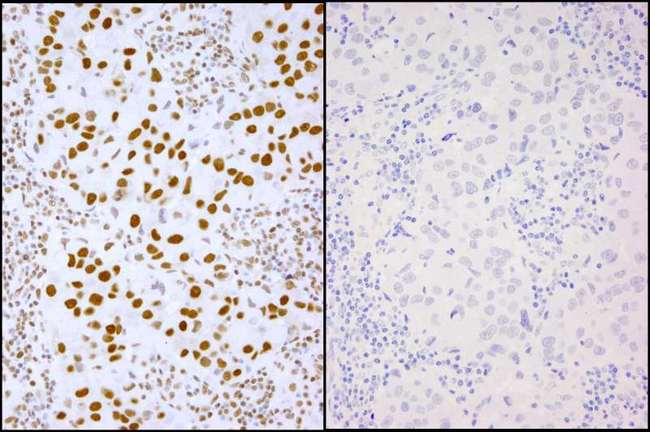 XRCC1 Antibody - Detection of Human Phospho XRCC1 (S485/T488) by Immunohistochemistry. Samples: FFPE serial sections of human breast adenocarcinoma. Mock phosphatase treated section (left) or calf intestinal phosphatase-treated section (right) immunostained for Phospho XRCC1 (S485/T488). Antibody: Affinity purified rabbit anti-Phospho XRCC1 (S485/T488). used at a dilution of 1:250.