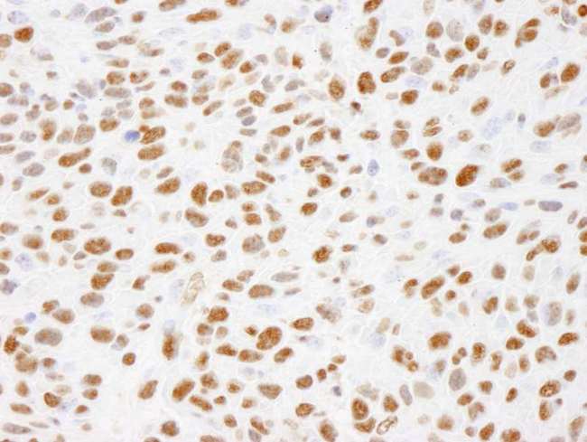 XRCC1 Antibody - Detection of Mouse Phospho XRCC1 (S485/T488) by Immunohistochemistry. Sample: FFPE section of mouse squamous cell carcinoma. Antibody: Affinity purified rabbit anti-Phospho XRCC1 (S485/T488). used at a dilution of 1:250.