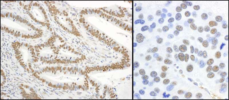 XRCC1 Antibody - Detection of Human and Mouse Phospho-XRCC1-S485/T488 by Immunohistochemistry. Sample: FFPE sections of human stomach carcinoma (left) and mouse renal cell carcinoma (right). Antibody: Affinity purified rabbit anti-Phospho-XRCC1-S485/T488 used at a dilution of 1:5000 (0.2 ug/ml). Detection: DAB.