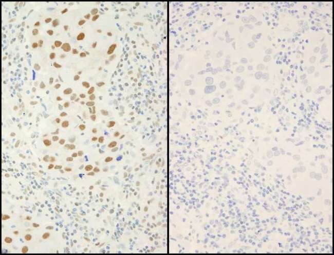 XRCC1 Antibody - Detection of Human Phospho XRCC1 (S518/T519/T523) by Immunohistochemistry. Samples: FFPE serial sections of human breast adenocarcinoma. Mock phosphatase treated section (left) or calf intestinal phosphatase-treated section (right) immunostained for Phospho XRCC1 (S518/T519/T523). Antibody: Affinity purified rabbit anti-Phospho XRCC1 (S518/T519/T523) used at a dilution of 1:250.