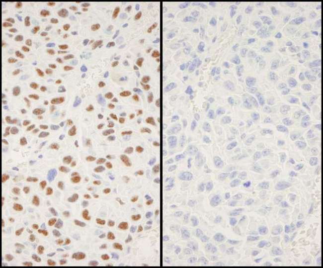 XRCC1 Antibody - Detection of Mouse Phospho XRCC1 (S518/T519/T523) by Immunohistochemistry. Samples: FFPE serial sections of mouse squamous cell carcinoma. Mock phosphatase treated section (left) or calf intestinal phosphatase-treated section (right) immunostained for Phospho XRCC1 (S518/T519/T523). Antibody: Affinity purified rabbit anti-Phospho XRCC1 (S518/T519/T523) used at a dilution of 1:250.
