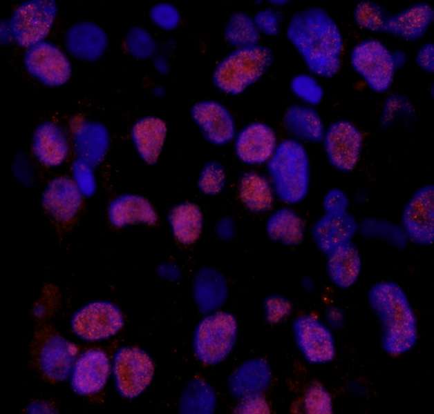 XRCC1 Antibody - Detection of Human Phospho XRCC1 (S518/T519/T523) by Immunofluorescence. Sample: FFPE section of human breast carcinoma. Antibody: Affinity purified rabbit anti-Phospho XRCC1 (S518/T519/T523) used at a dilution of 1:100. Detection: Red-fluorescent Alexa Fluor 555 goat anti-rabbit IgG (Invitrogen) used at a dilution of 1:500.