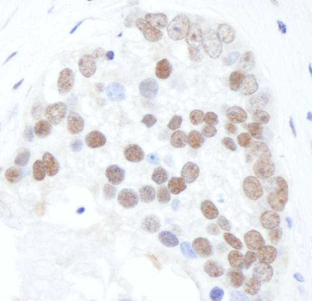 XRCC1 Antibody - Detection of Human Phospho-ERCC1 (S518/T519/T523) by Immunohistochemistry. Sample: FFPE section of human prostate carcinoma. Antibody: Affinity purified rabbit anti-Phospho-XRCC1 (S518/T519/T523) used at a dilution of 1:5000 (0.2 Detection: DAB.