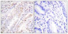 XRCC2 Antibody - Immunohistochemistry analysis of paraffin-embedded human lung carcinoma, using XRCC2 Antibody. The picture on the right is blocked with the synthesized peptide.