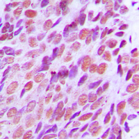 XRCC2 Antibody - Immunohistochemical analysis of XRCC2 staining in human breast cancer formalin fixed paraffin embedded tissue section. The section was pre-treated using heat mediated antigen retrieval with sodium citrate buffer (pH 6.0). The section was then incubated with the antibody at room temperature and detected using an HRP conjugated compact polymer system. DAB was used as the chromogen. The section was then counterstained with hematoxylin and mounted with DPX.